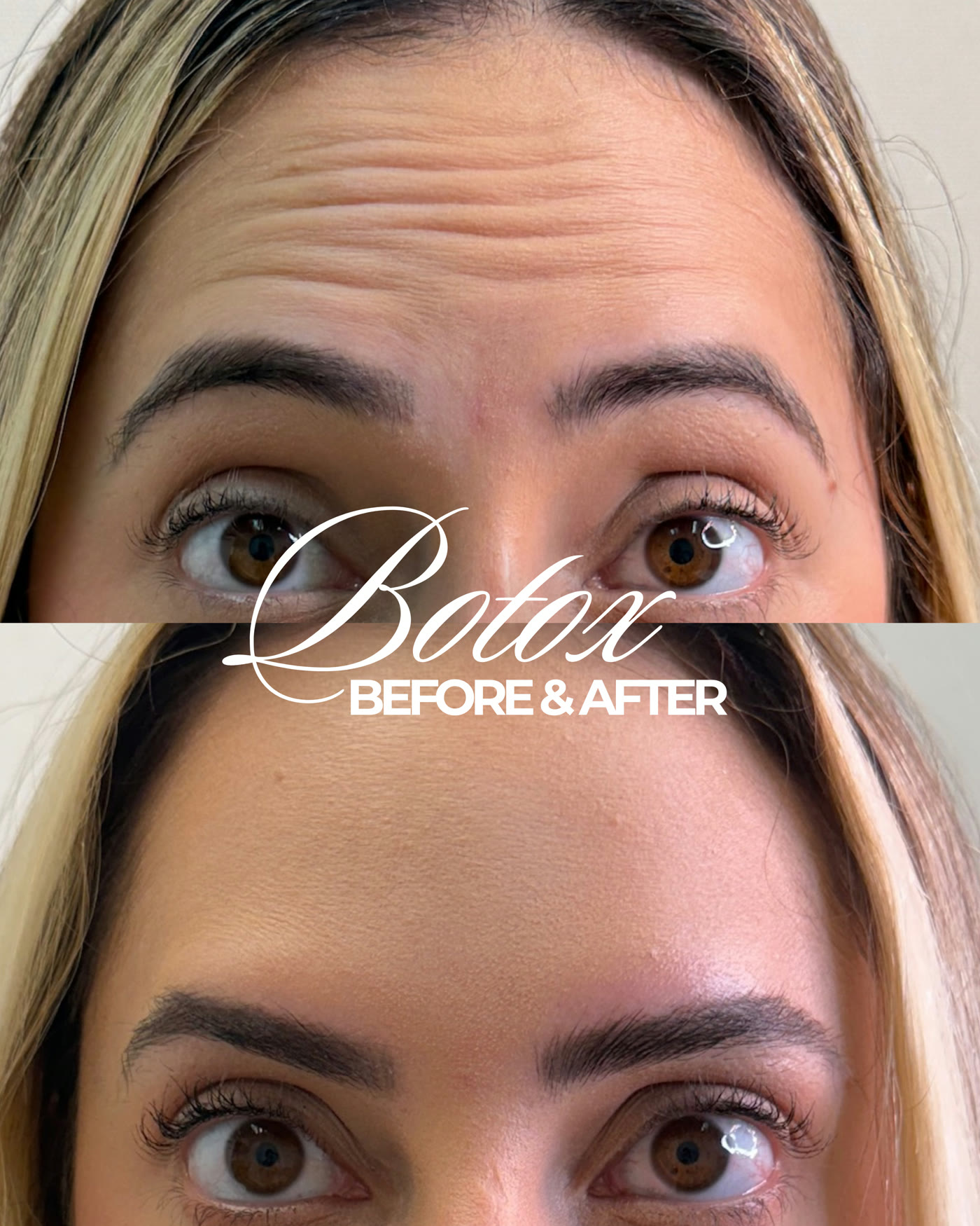 Botox — antes y después