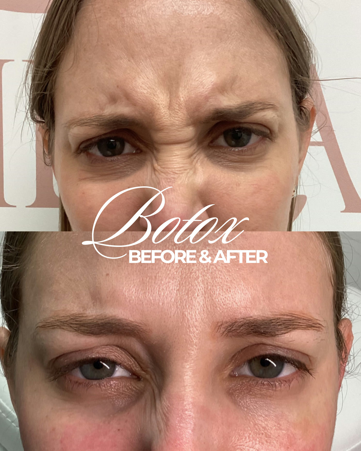 Botox — antes y después