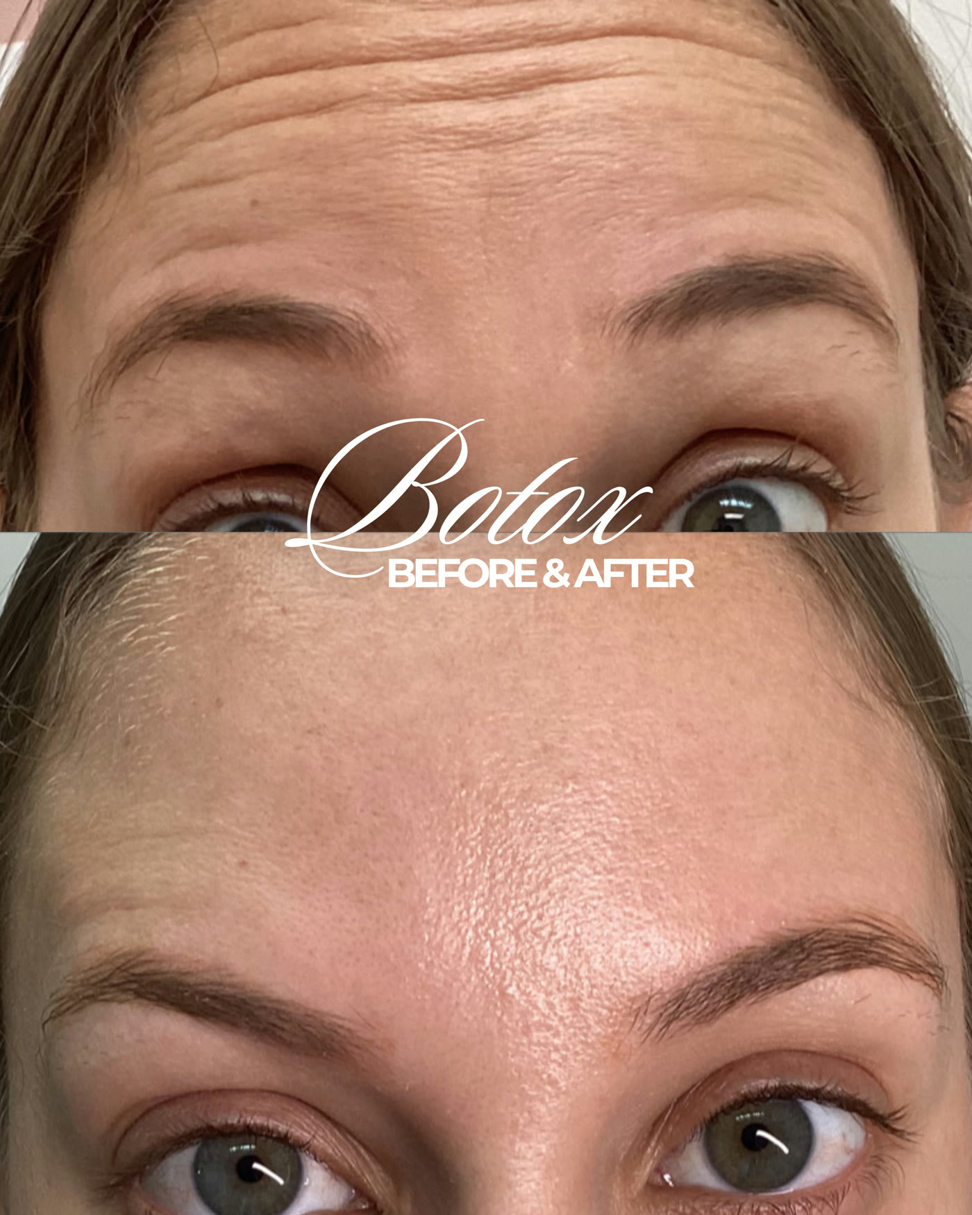 Botox — antes y después