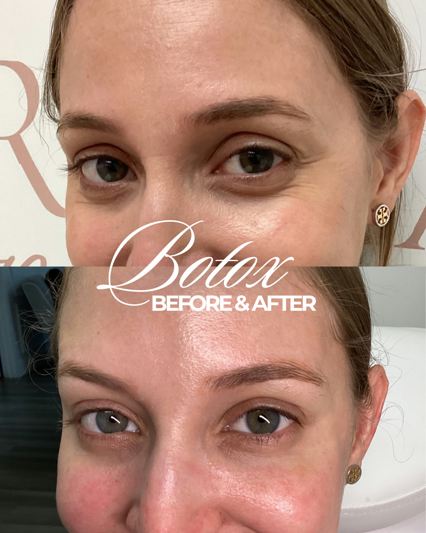 Botox — antes y después