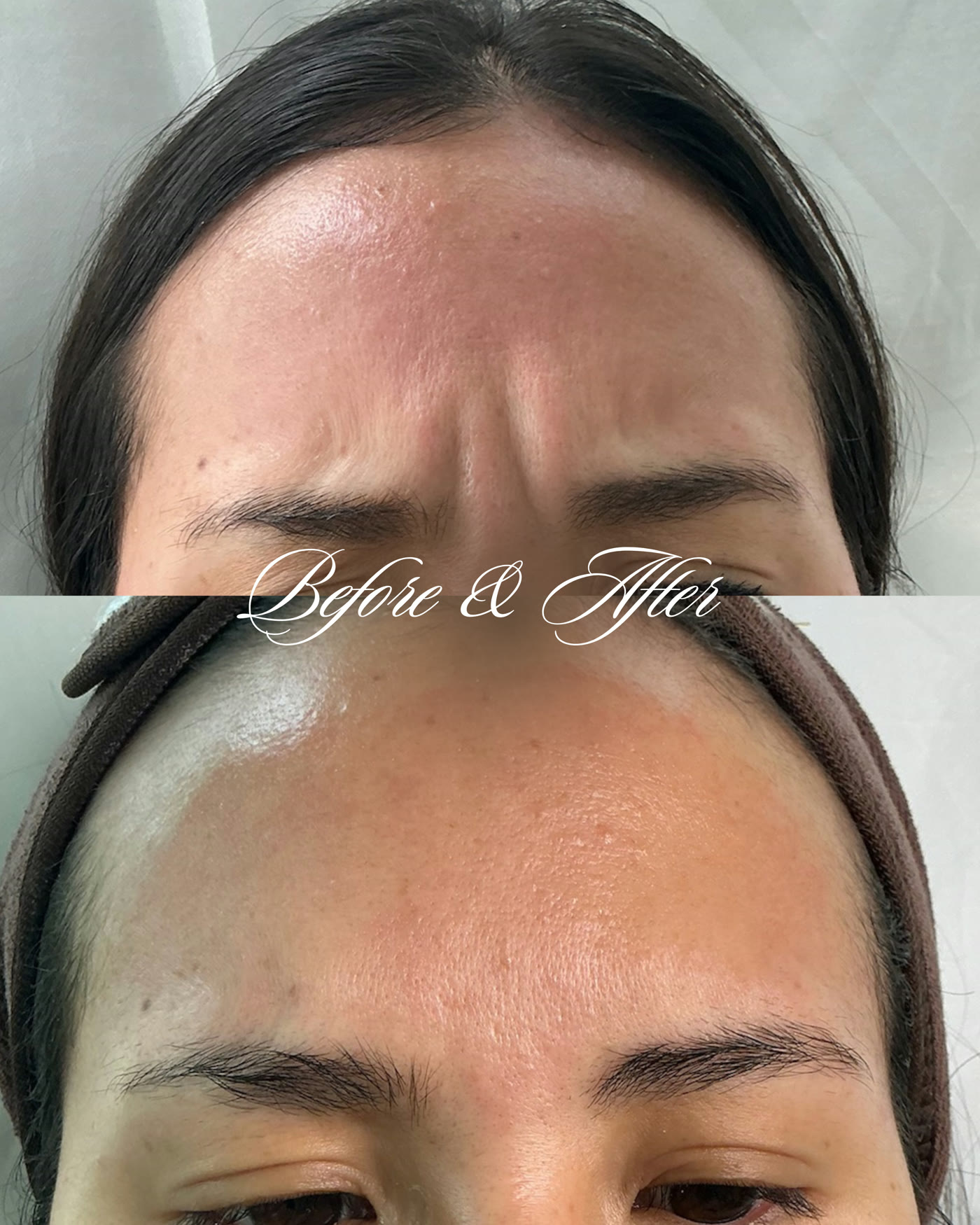 Botox — antes y después